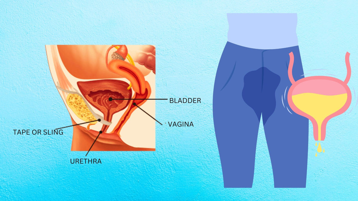 India’s Bladder Leak Problem: Survey of 500 Women Reveals Silent Suffering
